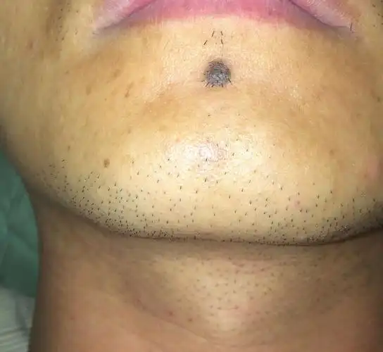 此外还易口无遮拦,说话没有把门,容易导致祸从口出下巴有痣的命理含义