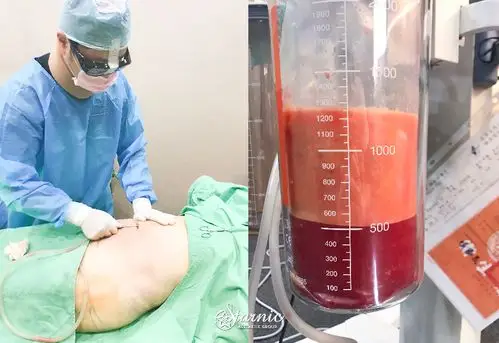 台中医美星和诊所_肚子抽脂_豆豆09