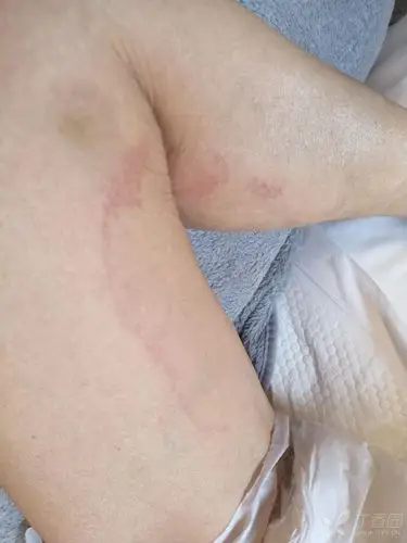 老人皮肤抓痕? - 皮肤与性传播疾病讨论版 -丁香园论坛