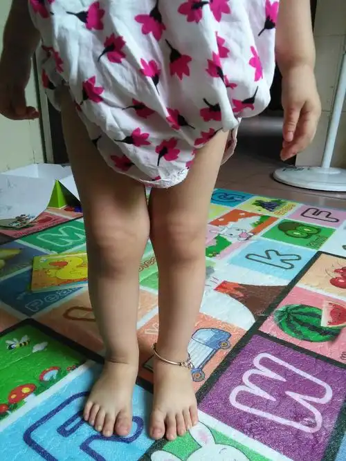 宝宝腿形这样正常吗? - 2013年7月妈妈帮 - 妈妈帮