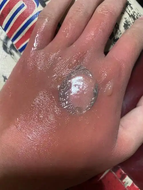 皮肤被油或开水烫伤后, 可用风油精万花油或植物油如麻油直接涂于伤面