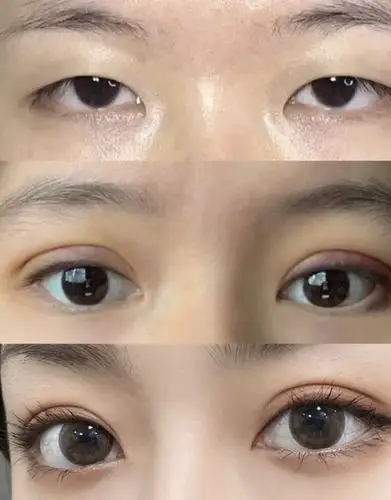 割完双眼皮50天效果图