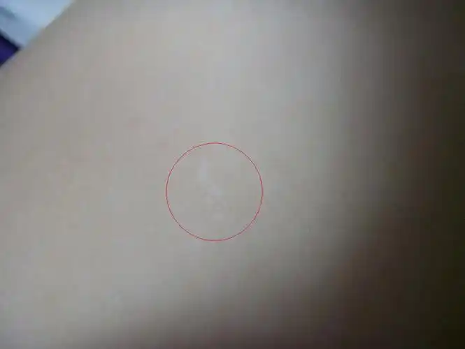 1岁3个月 宝宝 身上 白点 白斑 略微突出一点点 不是平的