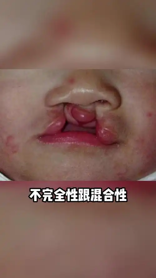 最严重的唇腭裂类型,修复