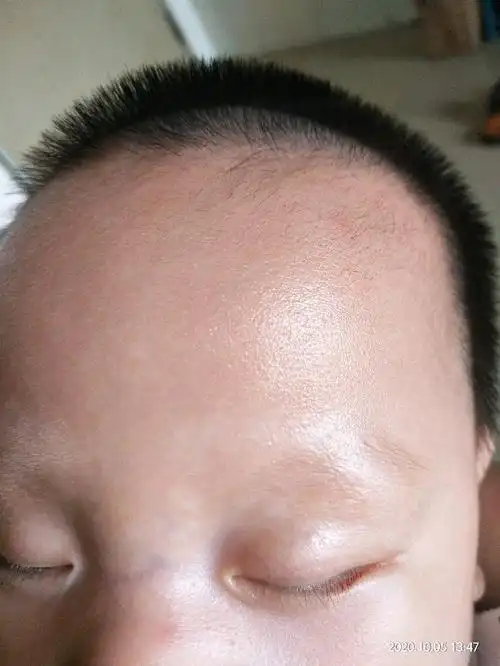 3个月宝宝长了花斑癣怎么办?