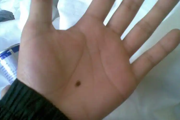 手心有痣好不好 说明心思缜密