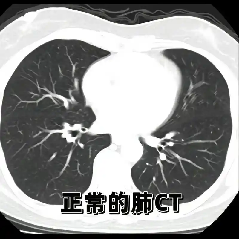 图一:正常的肺 ct 图二:纯实性结节: 纯实性结节类似于单独分离的