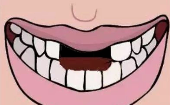 门牙摔掉了,也能种牙吗?