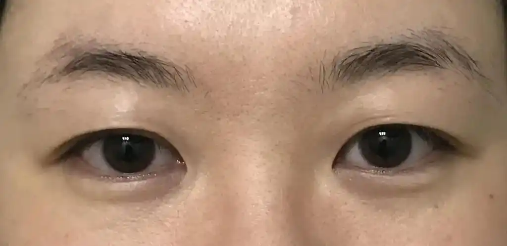 都可以通过重睑术去除多余松弛的皮肤形成新的双眼皮