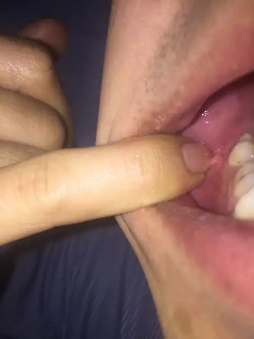 右侧牙根牙龈处长个肉揪 是瘤吗