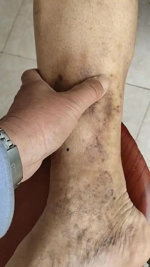 下肢静脉曲张,小腿酸胀无力,有硬块,皮肤颜色发紫.