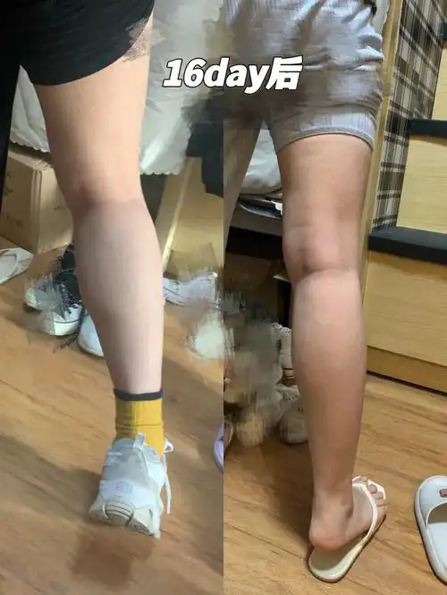 怎么引起粗壮的?p3(小腿图解)78小腿粗壮一般是由腓肠肌