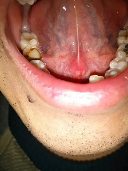 最近两天,感觉舌头下面很不舒服,对着镜子照了以后,发现舌头下面有两