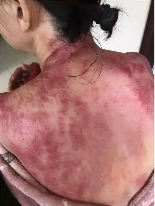 中西医声 | 咳嗽,感冒,不敢轻易去医院?今天教你在家刮痧保健!