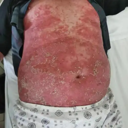 中医和西医在皮肤病的认识上不同