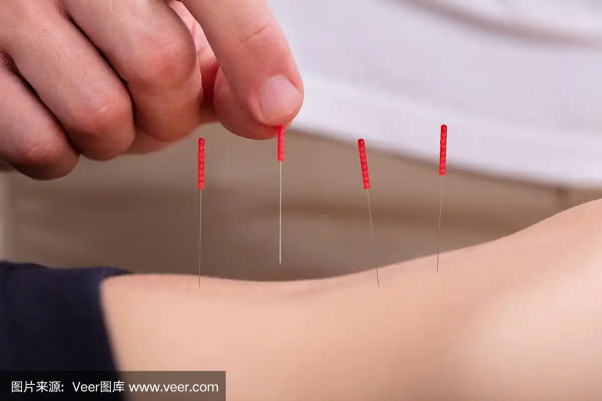 女人接受针灸治疗的腹部特写