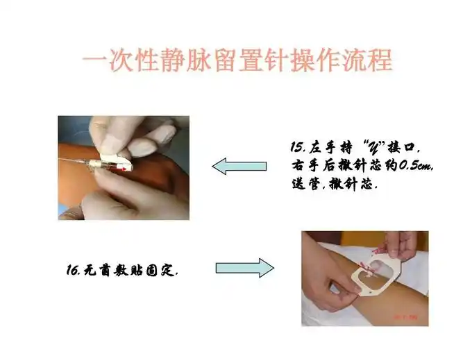 一次性静脉留置针操作流程[1]ppt