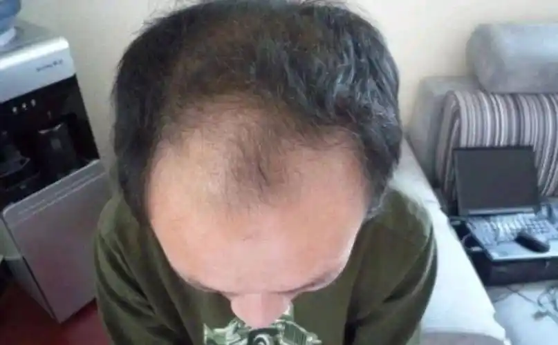 程序员男同事,才30岁就开始有了"秃顶危机",看起来像个中年大叔,一直