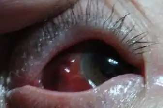 眼睛突然充血是怎么回事啊?应该怎样治疗解决和注意什么呢?