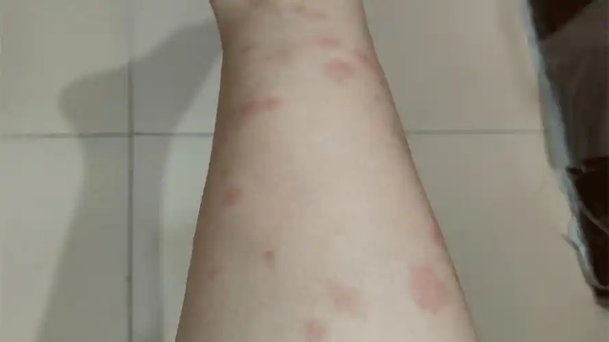 蚊子咬后涂点止痒膏就能消退但是遇到这种"大红包"那就麻烦了0202