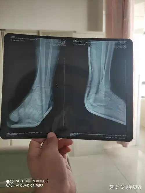 左脚踝撕脱性骨折 - 知乎