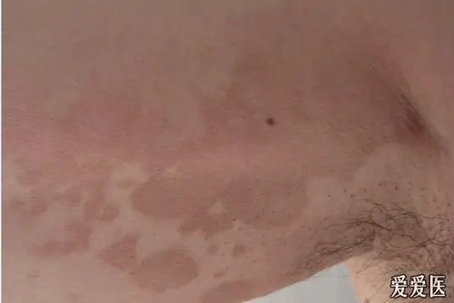 花斑癣? - 皮肤及性传播疾病讨论版 - 爱爱医医学论坛