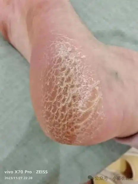 皮肤科查体:双脚后跟可见表皮角化增厚,粗糙,鳞屑,前脚掌皮肤尚可.