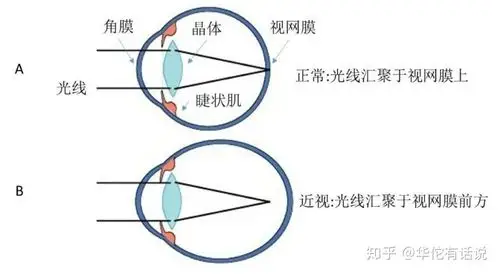 其聚焦在视网膜之前,这导致视网膜上不能形成清晰像,称为近视眼