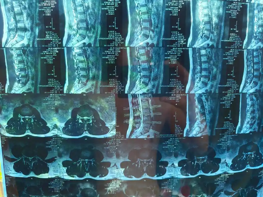 腰椎间盘突出   保守治疗88天.谁家的鸡都开始打鸣了,我还 - 抖音