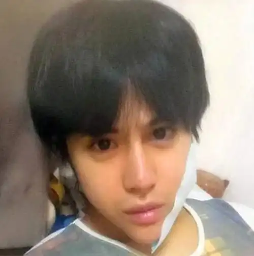 这是一位日本名叫allen的男子,疯狂整容数十次,整成了一张"蛇精脸