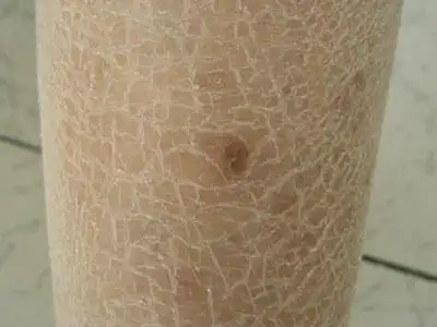 冬天皮肤干燥起皮怎么办 如何应对皮肤干燥