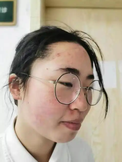 脸上留下了护目镜和口罩的印痕