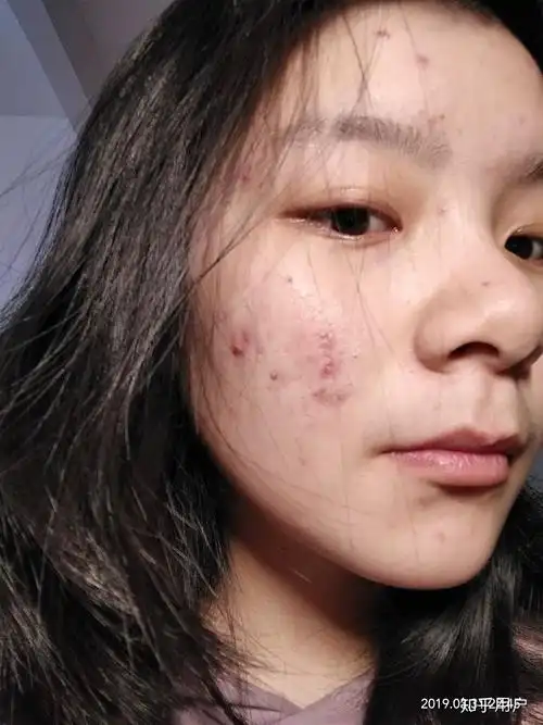 有没有长得好看但长痘痘的女生? - 知乎