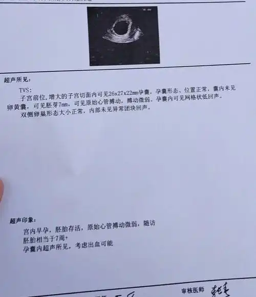 4,停经45天,hcg和孕囊一直在发育,今天做阴超,换了三个医生给我看,都