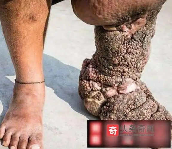 世界最恶心的十种病:世界上十大奇葩病|图文|世界最