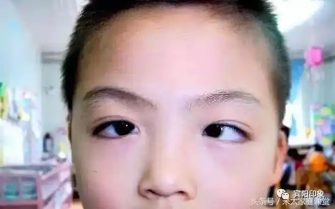 七岁男孩吃鸡不成反成斗鸡眼宾阳家长可要注意了