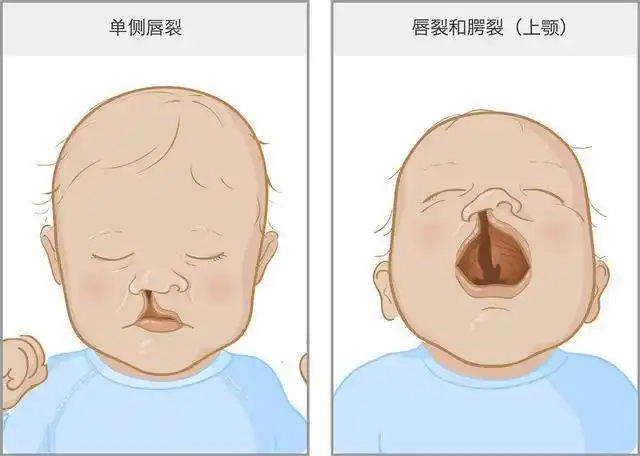 术后说话不清楚鼻腔漏气是腭裂修复手术失败了吗