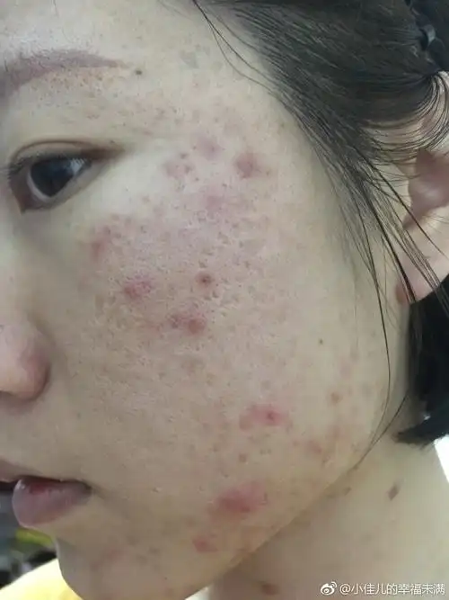 痘痘肌救星—卡姬兰修复霜