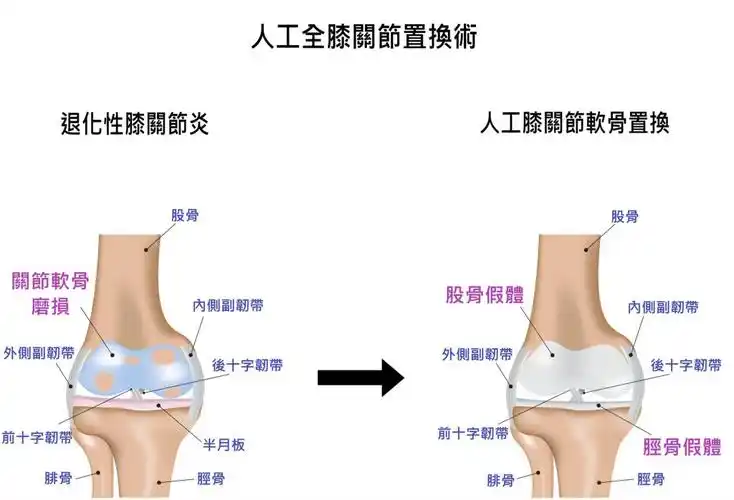 人工全膝关节置换——右膝关节剖析图