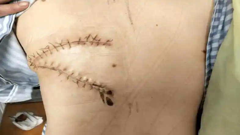 甲乳外科首例拆东墙补西墙手术成功修复乳癌术后巨大创面