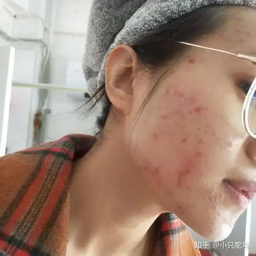 点阵激光失败案例 术后自我修复之路