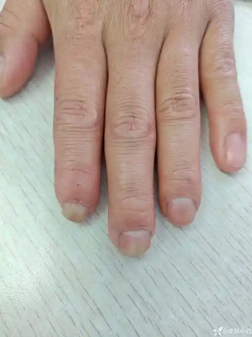 病历讨论甲床畸形如何纠正