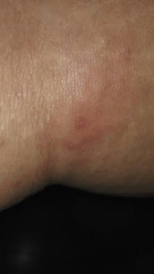 我的膝盖窝里肿了一块 然后硬邦邦 按下去就疼 蹲下的时候也疼 只有