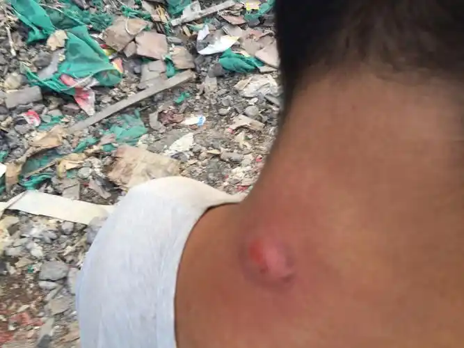 脖子后面长了一个大豆,会痛,挤出来有水也有白物体