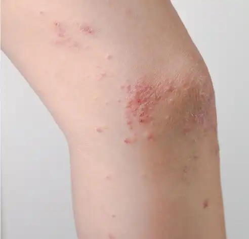 棒!湿疹图片初期症状图"送子天下"-第2张图片-柔情博客
