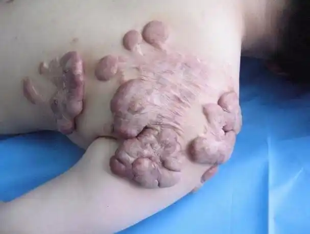 疤痕增生的消退过程.疤痕增生六个月之后会慢慢消退?