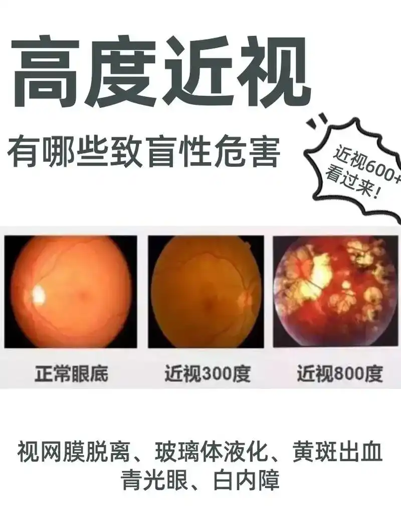 近视600度以上就是所谓 - 抖音