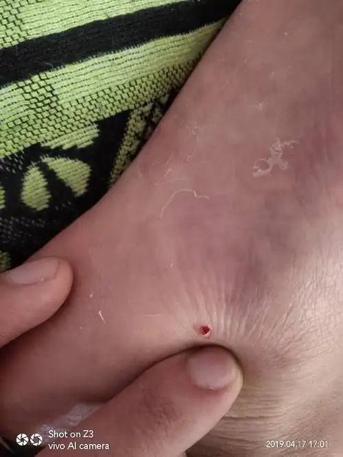 脚不小心被钉子插了一口,当时出血很少的血,伤口也不是很深,然后我用