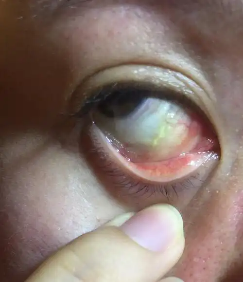 大夫您好上周四早上发现内眼角有透明条状泡周五变黄了一点