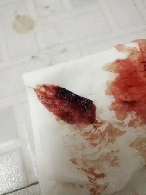 大姨妈来了比之前量多是怎么回事为什么月经会突然来多-赛宜网